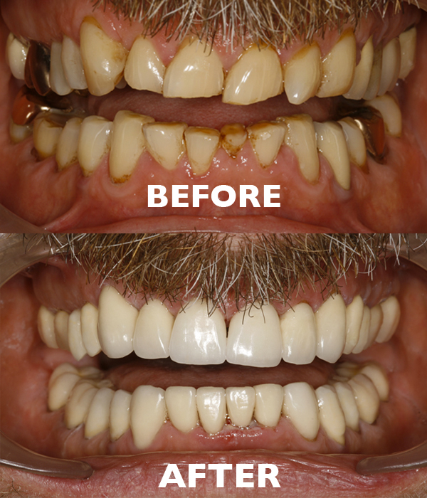 before and after dental services before and after dental services