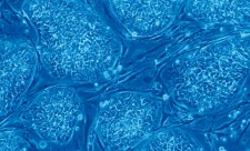 Costa Rica Stem Cells Transplant
