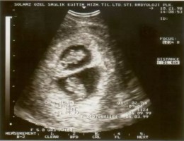 Twin ultrasound. Source: Wikimedia Commons