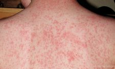 Costa Rica Measles Vaccination